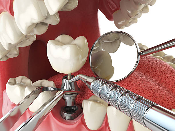 Best Knocked-Out Tooth Emergency  in Barnesville, MN